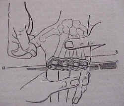 dfingerampution.JPG (50419 bytes)